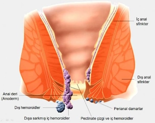 Anüs Hastalıkları Belirtileri ve Tedavisi