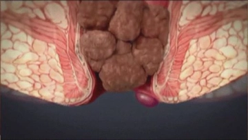 Anüs Kanaması Belirtileri ve Tedavisi